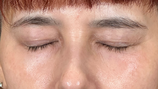 手术后的状态 其一