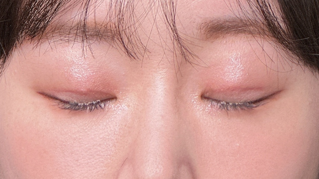 Postoperative Condition Part 1