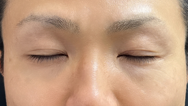 手术后的状态 其一