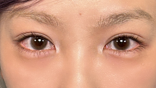 手术后的状态 其一