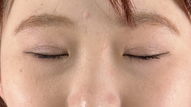 Postoperative Condition Part 1