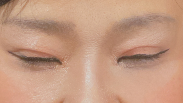 手术后的状态 其一