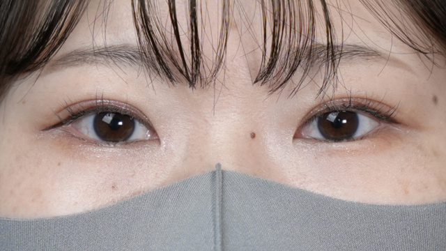 手术后的状态 其一