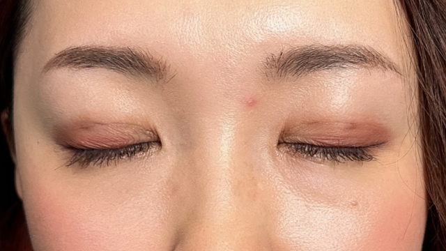 手术后的状态 其一