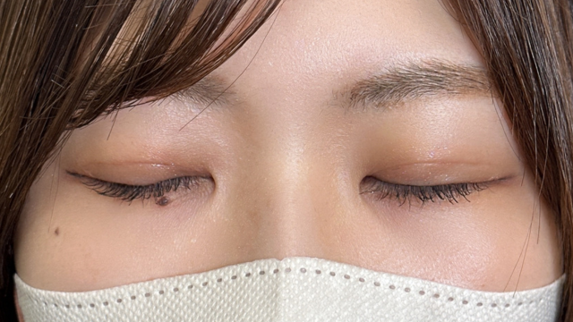 手术后的状态 其一