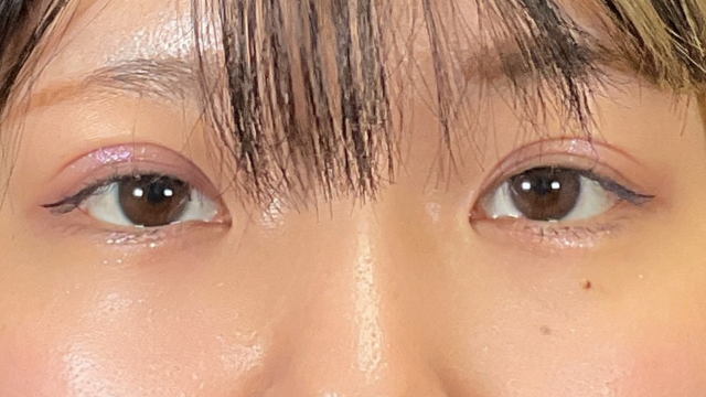 手术后的状态 其一