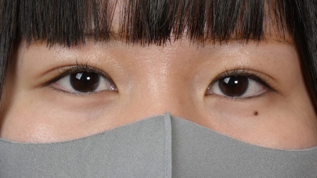 手术后的状态 其一