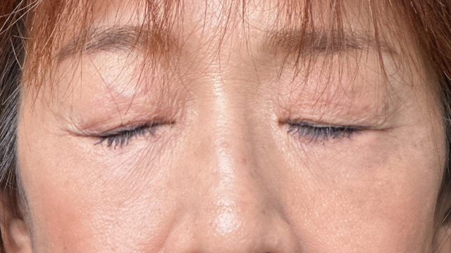 手术后的状态 其一