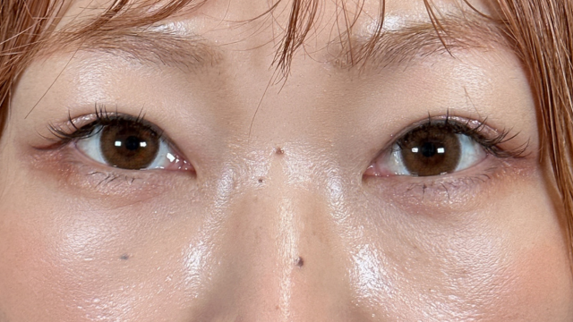 手术后的状态 其一