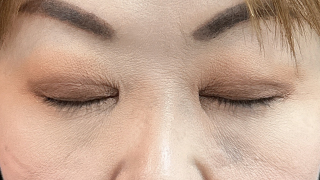 手术后的状态 其一