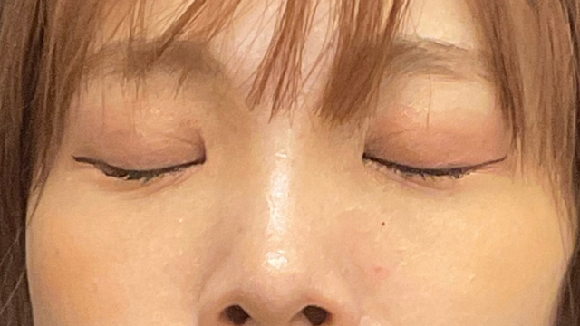 手术后的状态 其一