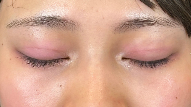 手术后的状态 其一