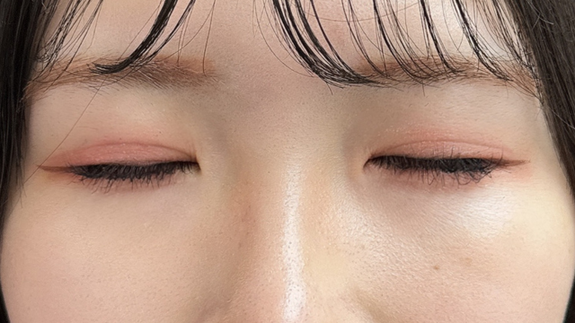 手术后的状态 其一