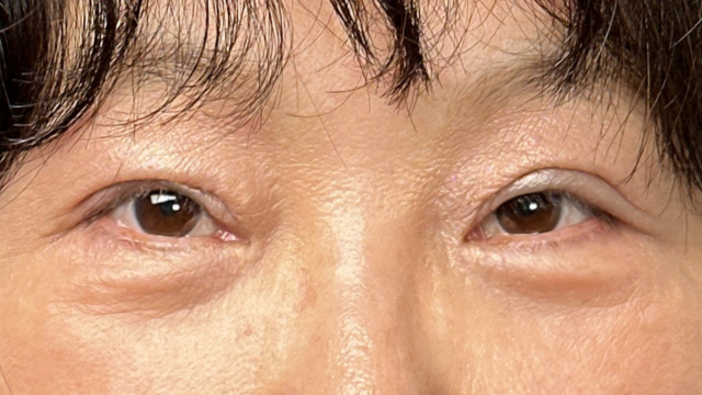 手术后的状态 其一