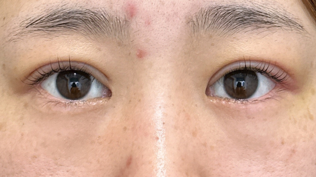 手术后的状态 其一