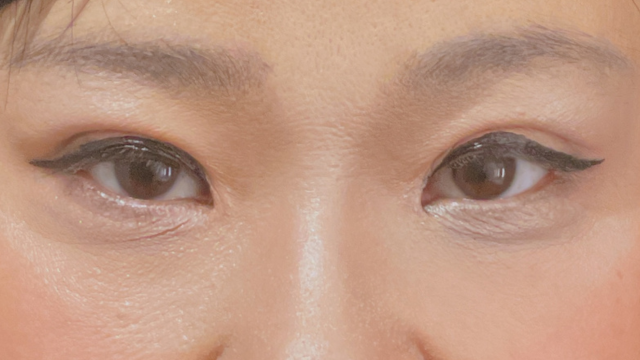 手术后的状态 其一