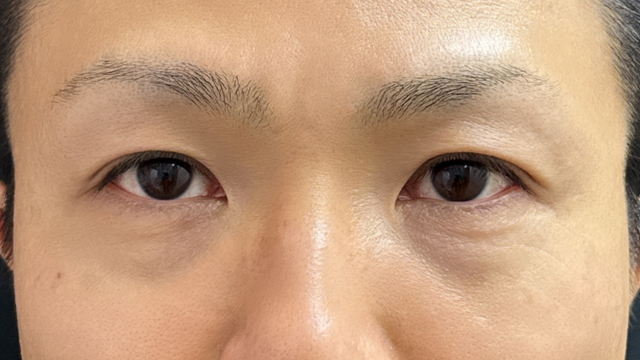 手术后的状态 其一