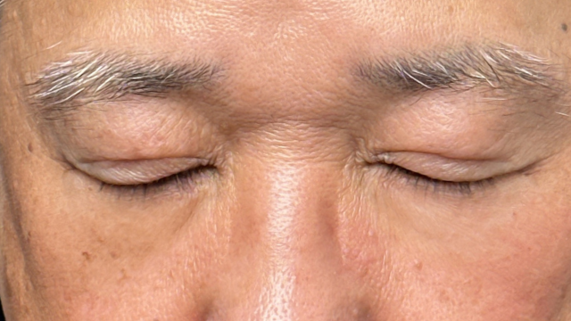 手术后的状态 其一