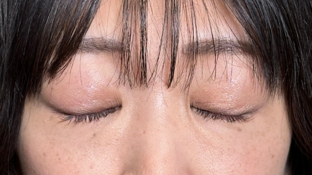 手术后的状态 其一