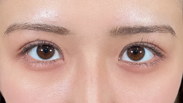 手术后的状态 其一