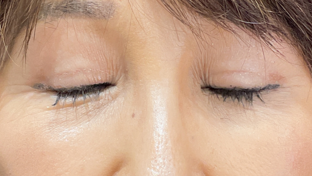 手术后的状态 其一