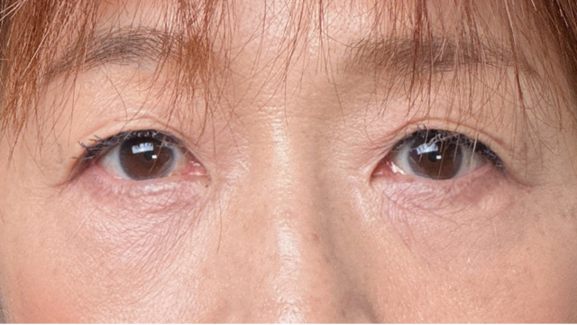 手术后的状态 其一