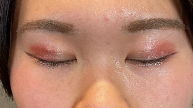 手术后的状态 其一