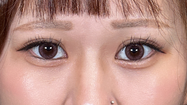 手术后的状态 其一