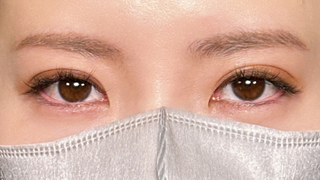 手术后的状态 其一