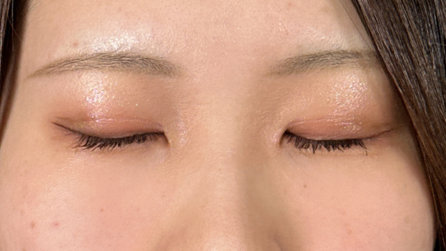 手术后的状态 其一