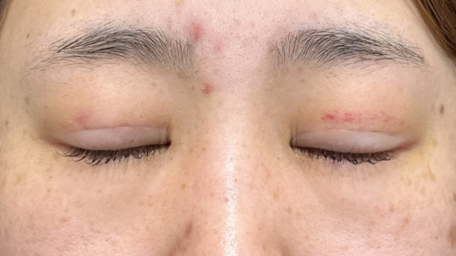 手术后的状态 其一