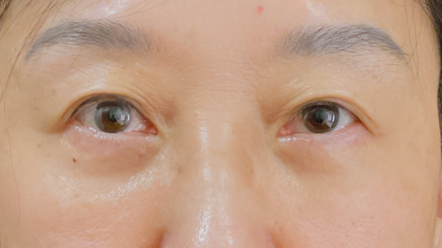 手术后的状态 其一