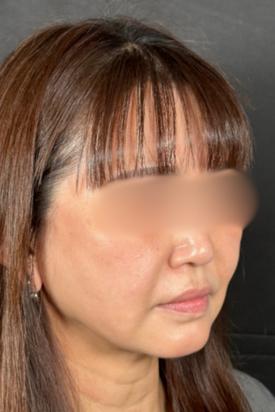 手术后的状态 其一