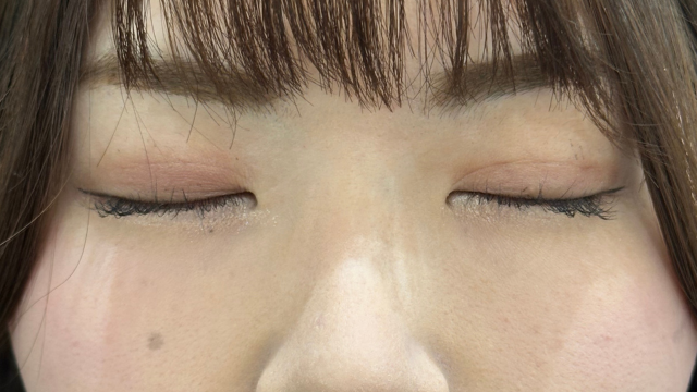 手术后的状态 其一