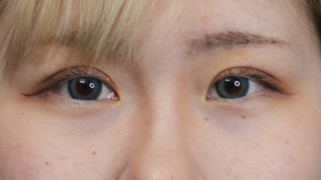 手术后的状态 其一