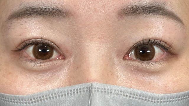 手术后的状态 其一