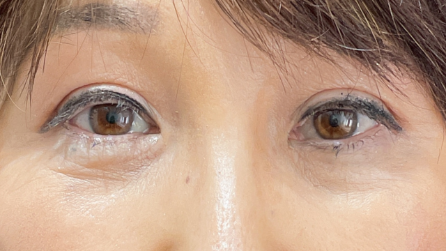 手术后的状态 其一