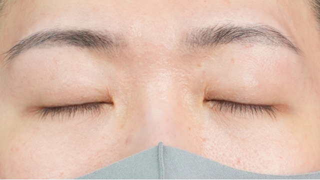 手术后的状态 其一