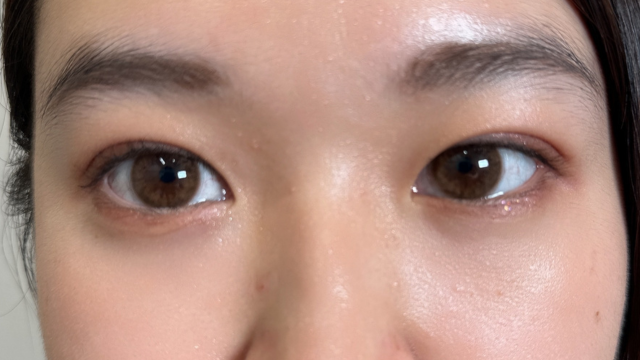 手术后的状态 其一