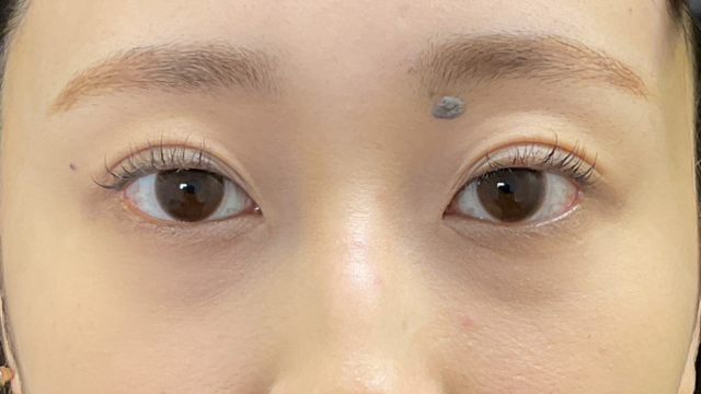 手术后的状态 其一