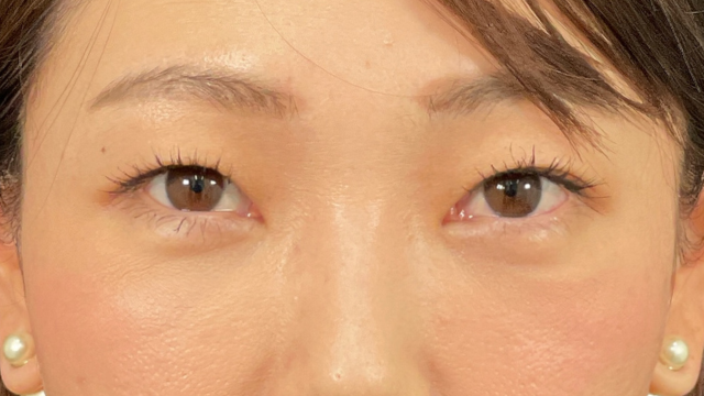 手术后的状态 其一