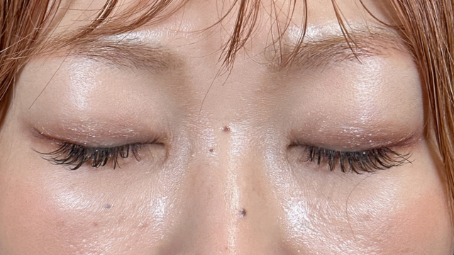 手术后的状态 其一