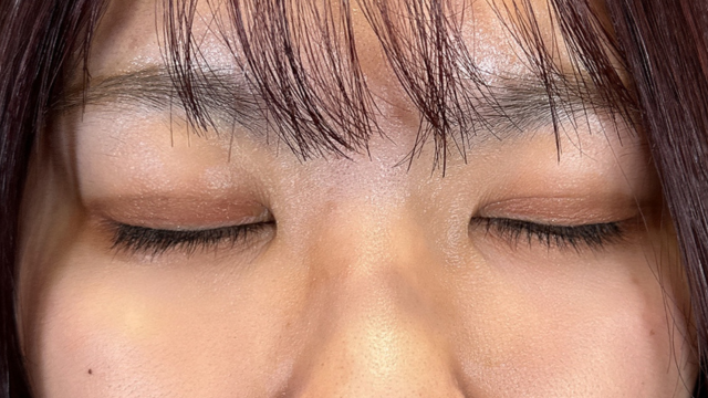 手术后的状态 其一