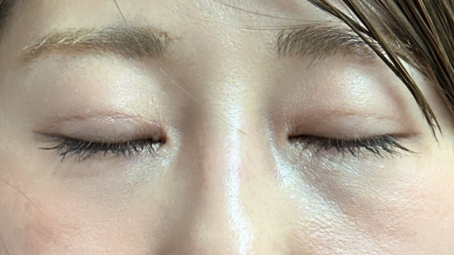 手术后的状态 其一