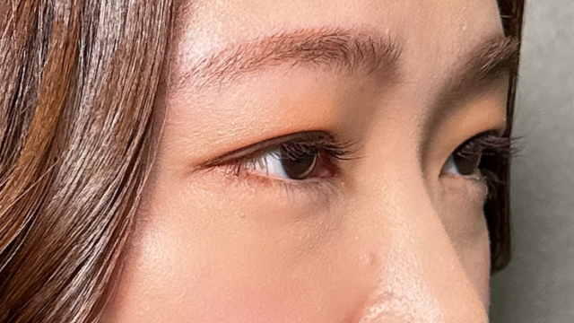 手术后的状态 其一