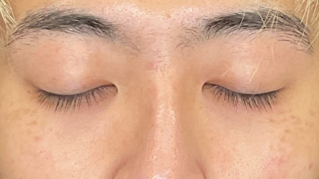 手术前的状态 其一