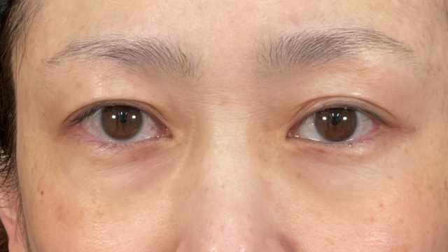 手術前の状態 その1