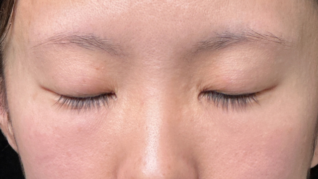 手术前的状态 其一