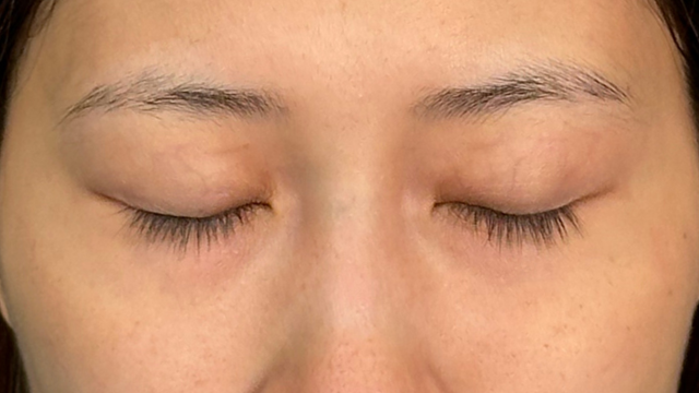 Postoperative Condition Part 1