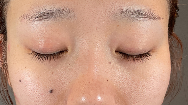 手术前的状态 其一